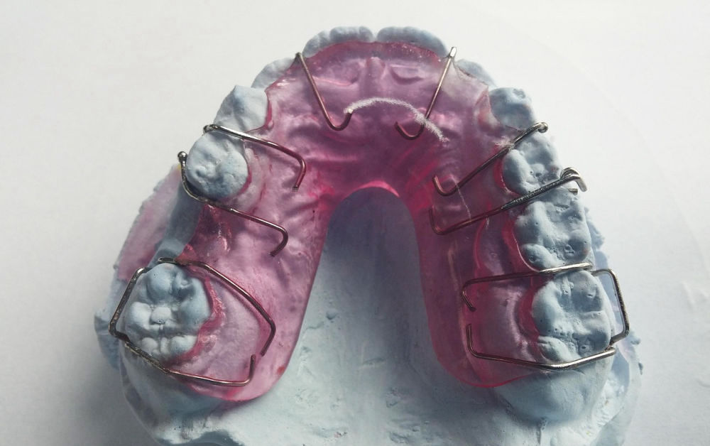 Gipsmodel mit Zahnspange