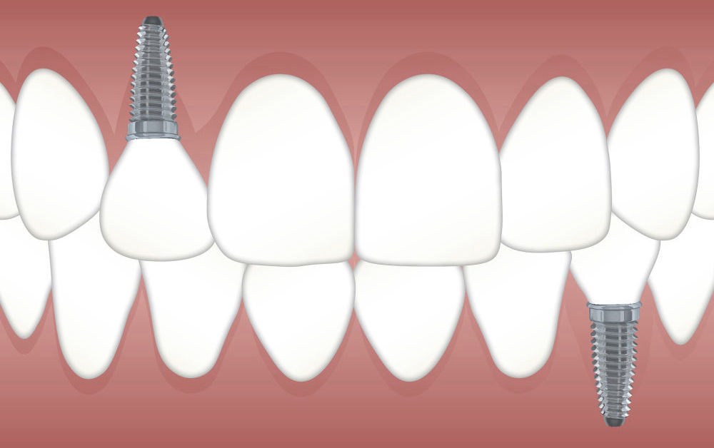 grafische Darstellung Gebiss mit Zahnimplantat